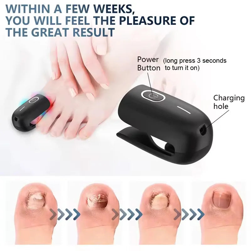 KTS Nail Fungus Laser Device