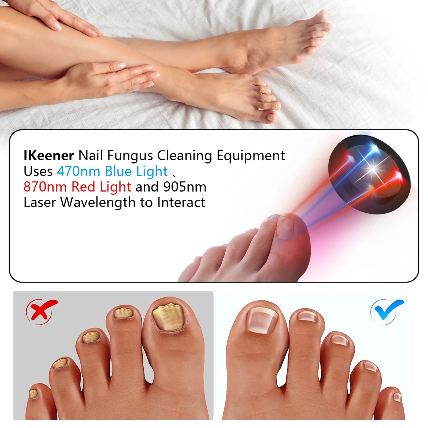 KTS Nail Fungus Laser Device
